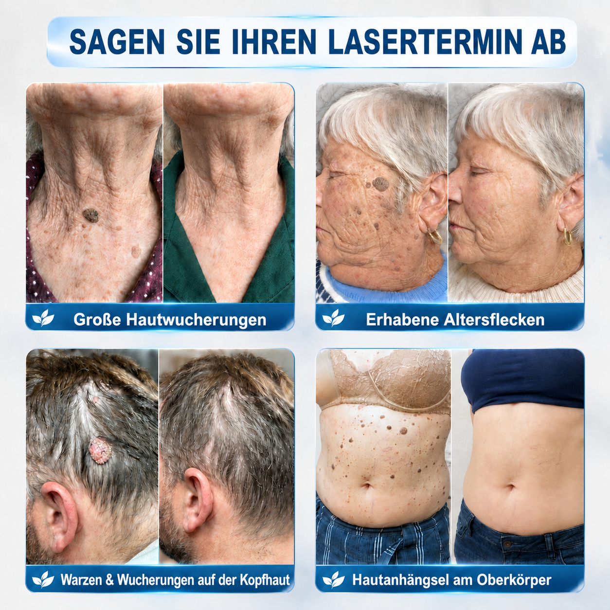 HISKIN®👩‍⚕️ 7-Tage-Hautmakel- & Hautanhängsel-Entferner Schmerzfreier Rollerball-Stift zur schonenden Entfernung von Hautanhängseln und Hautflecken – narbenfrei