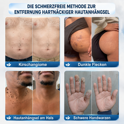 HISKIN®👩‍⚕️ 7-Tage-Hautmakel- & Hautanhängsel-Entferner Schmerzfreier Rollerball-Stift zur schonenden Entfernung von Hautanhängseln und Hautflecken – narbenfrei