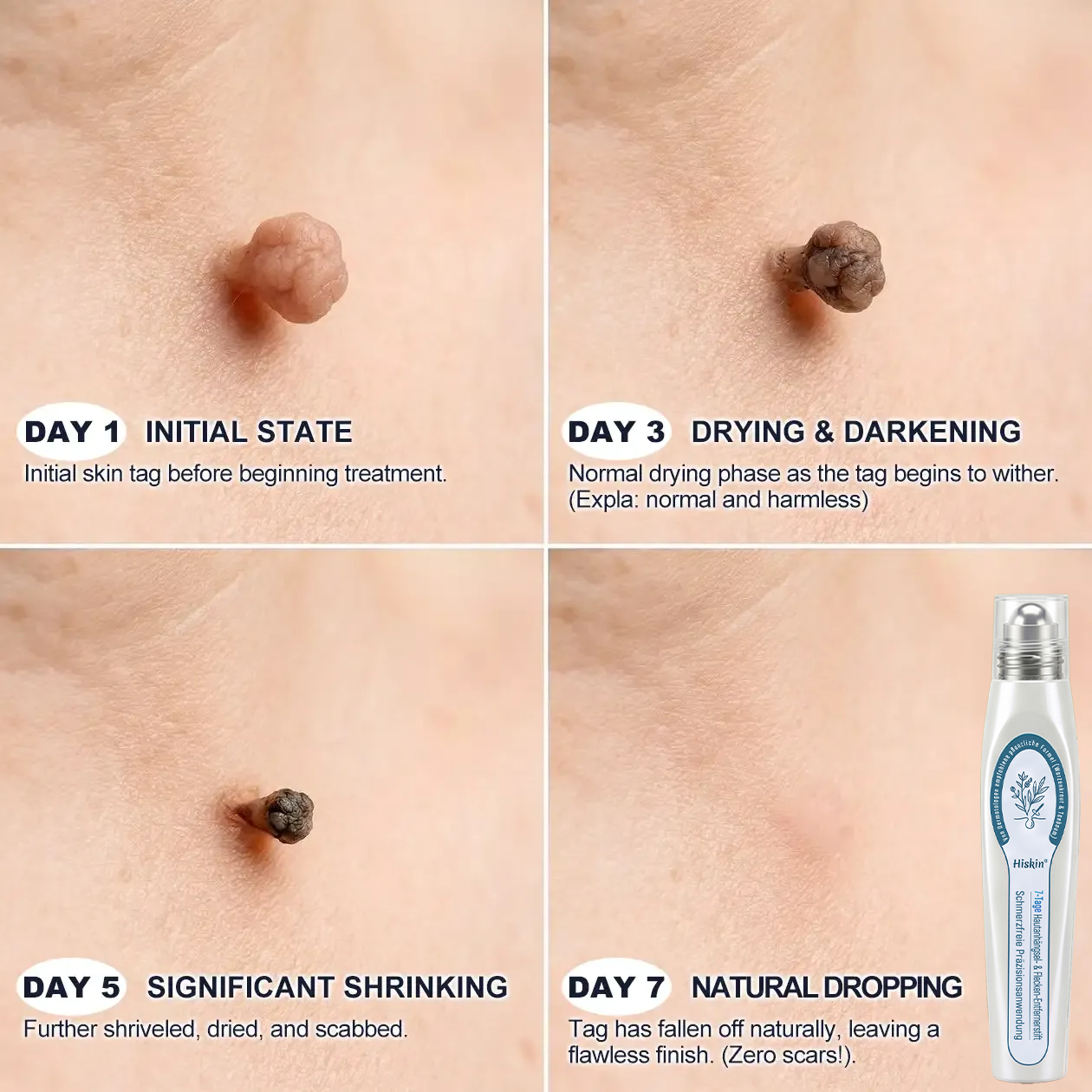 HISKIN®👩‍⚕️ 7-Tage-Hautmakel- & Hautanhängsel-Entferner Schmerzfreier Rollerball-Stift zur schonenden Entfernung von Hautanhängseln und Hautflecken – narbenfrei