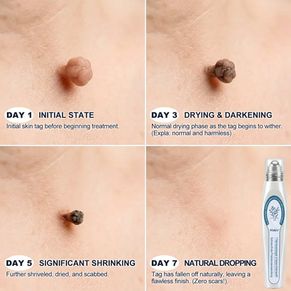 HISKIN®👩‍⚕️ 7-Tage-Hautmakel- & Hautanhängsel-Entferner Schmerzfreier Rollerball-Stift zur schonenden Entfernung von Hautanhängseln und Hautflecken – narbenfrei